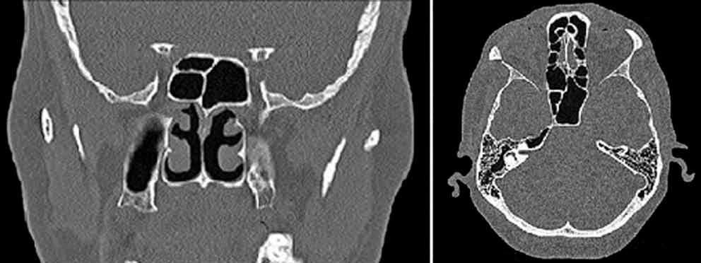 [6] Transfenoidal cerrahi koridorda karotis kabarıklık, optik kabarıklık ve optikokarotis reses gibi önemli yol gösterici anatomik yapılar net olarak görülebilmektedir.