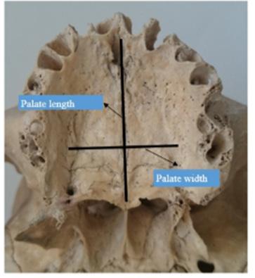 YILMAZ ve ark. INTRODUCTION The hard palate forms most of the roof of the oral cavity. Its anterior ¾ is formed by the maxilla, while the os palatinum forms the remaining posterior ¼.