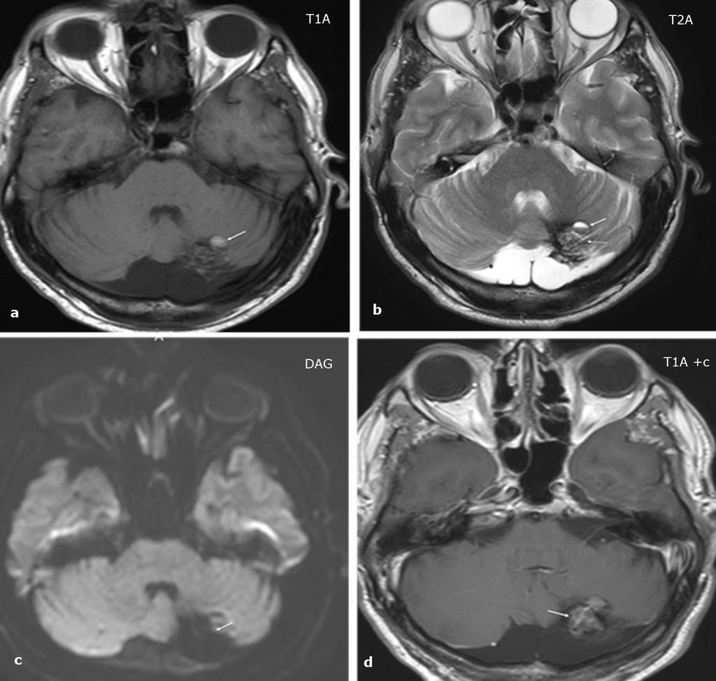 kesintili, hipointens hemosiderin halkası görülüyor (beyaz oklar). c) Difüzyon ağırlıklı görüntüde KVM olduğundan büyük boyutta görülüyor (beyaz ok).