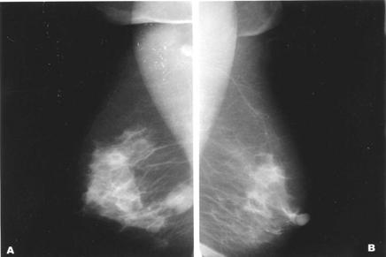 220 CERRAHPAŞA TIP DERGİSİ Cilt (Sayı) 34 (4) fından muayenesi ve mamografi önemli yere sahiptir.