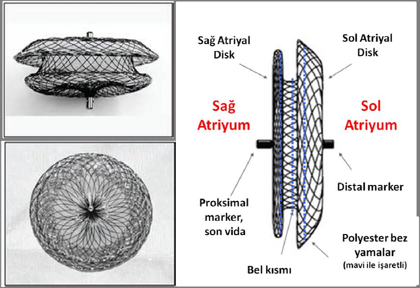 2.9.2.3 Transkatater ASD ve PFO kapatma cihazları ve cihaz seçimi Günümüzde dünya çapında kullanılan 15 adet ASD kapatma cihazı mevcuttur.