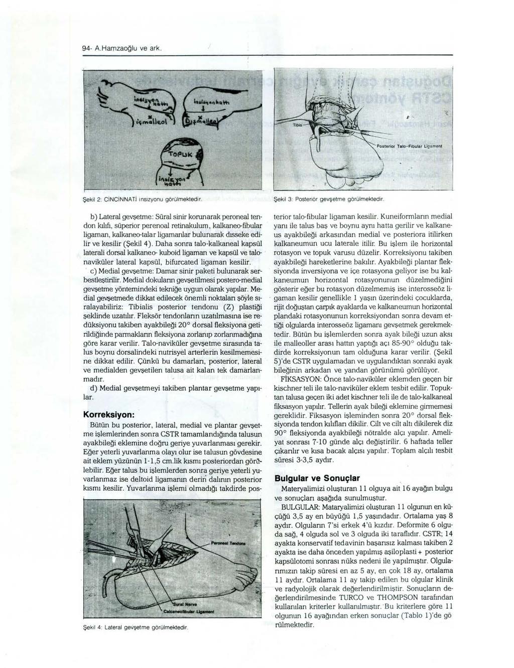 94- A.Harnzaoğlu ve ark. Şekil 2: CiNeiNNATi insizyonu görülmektedir. Şekil 3: Posteriör gevşetme görülmektedir.
