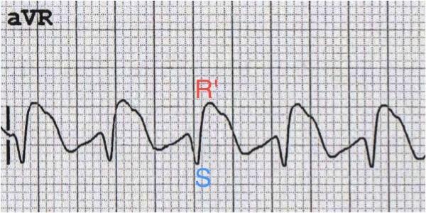 Soru 6: TSAD Zehirlenmelerindeki tipik EKG bulguları nelerdir?