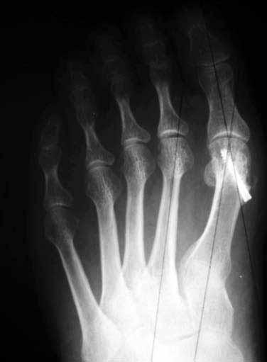 500 Acta Orthop Traumatol Turc (a) (c) 18 35 13 4 (b) (d) Şekil 3. Sol halluks valgus nedeniyle ameliyat edilen 52 yaşında bir kadın hastanın ameliyat öncesi (a) ön-arka ve (b) yan grafileri.