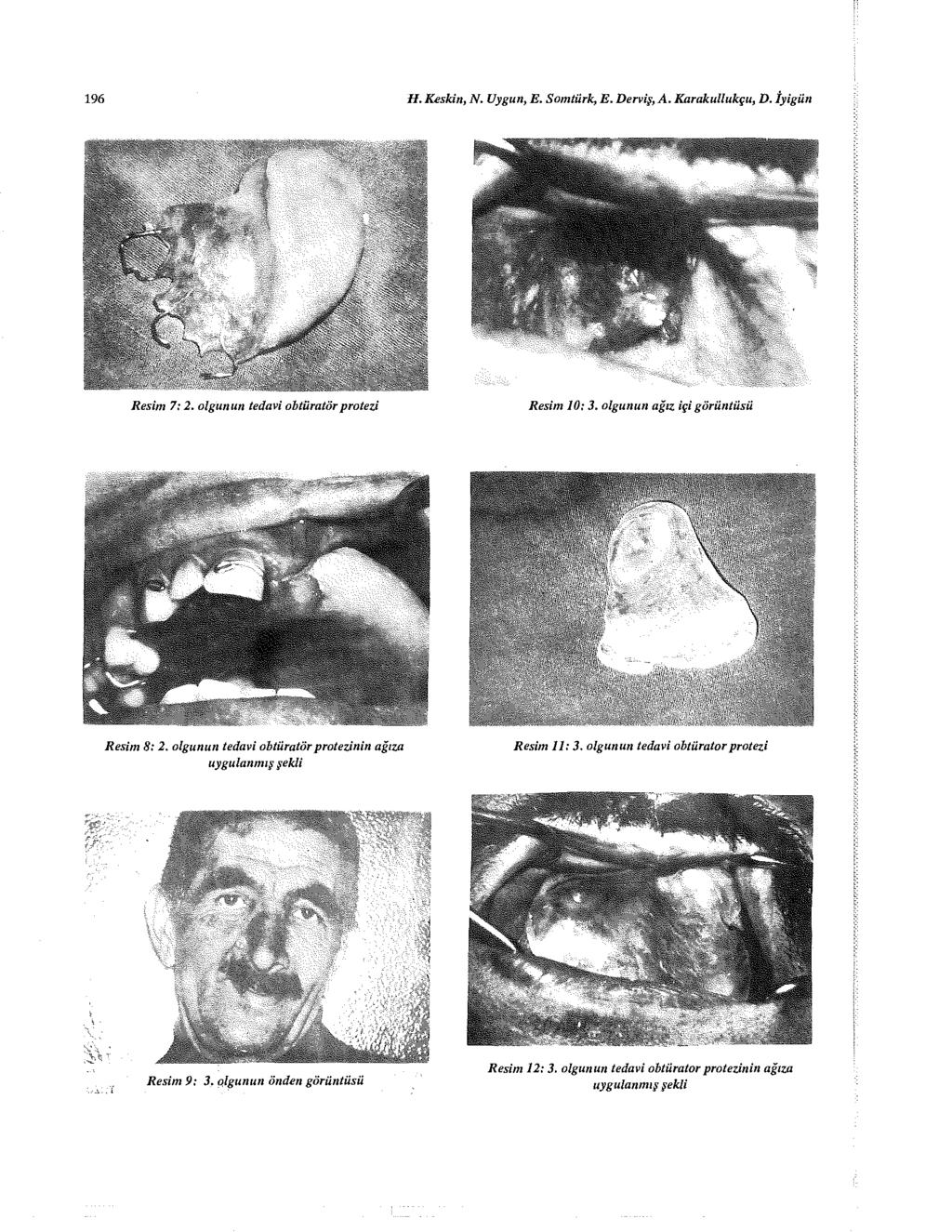 196 //. Keskin, N. Uygun, E. Somtürk, E. Derviş, A. Karakullukçu, D. İyigün İ M İ l Resim 7: 2. olgunun tedavi obtiiratör protezi Resim 10: 3. olgunun ağız içi görüntüsü Resim 8: 2.