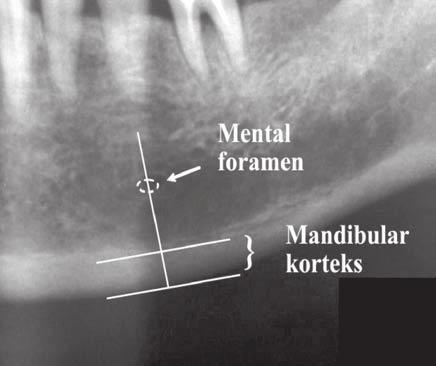 24 ise, menapoz sonras dönemde yer alan 227 sa l kl bayanda iskeletsel BMD taramas yap lm fl ve iskeletsel BMD de eri yüksek olanlarda derin periodontal ceplerinin bulunmas na ra men, difl kay p