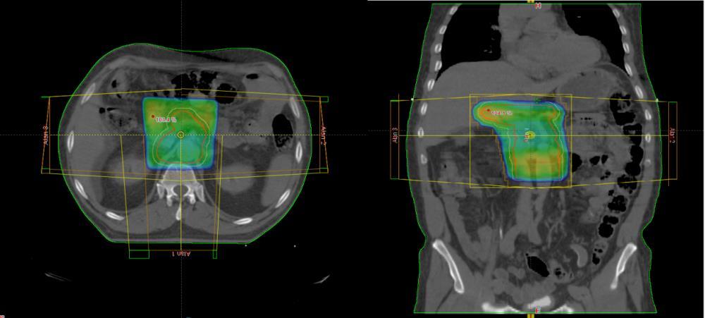 38 Şekil 3.24. Aynı olguda %95 lik dozu alan hacmin aksiyel ve koronal kesitteki görüntüsü. 3.2.3. YART Planlarının Yapılması YART tekniğinde her bir hasta için boş ve dolu mideyi içeren BT kesitleri üzerinde 5alan ve 7alan kullanılarak tedavi planları yapılmıştır.