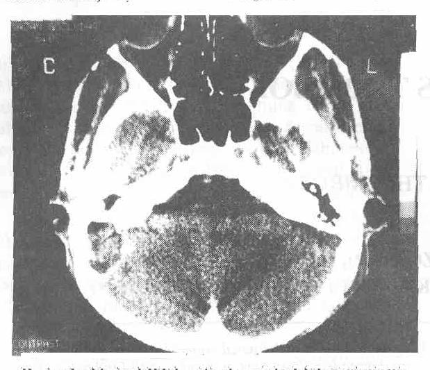 Ot: Serdar ENSARI ve ark. Hastaya yapılan substraksiyon venografide sağda LST belirlendi (Resim 3). Resim 3: Substraksiyon venografide LST görünümü. Resim 1: Aksiyel BT kesitinde sağda LST görünümü.