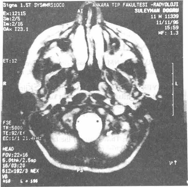 K.B.B. ve Baş Koyun Cerrahisi Dergisi, 5 : 229-233, 1997 fasial sinirin tümör tarafından infiltre olduğu görülerek faisal sinir eksizyonu gerçekleştirildi, ardından XII'VII kraniel sinir anastomozu