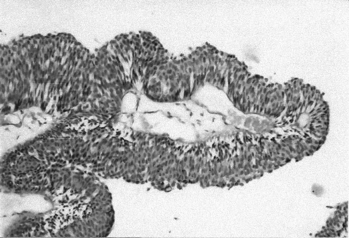 Kapucuoðlu, Mesane deðiþici epitel hücreli tümörleri 3 Resim 1 : WHO 1973 sistemine göre grade I karsinom, WHO/ISUP 1998 ve WHO 1999 sistemlerine göre düþük malign potansiyelli papiller üretelial