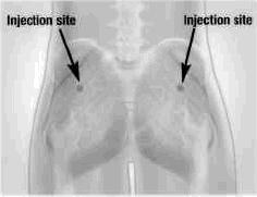 8. Adım Sandostatin LAR yalnızca derin intragluteal enjeksiyon yoluyla verilmelidir; ASLA intravenöz biçimde uygulanmaz.