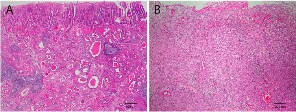 Resim 1. A. Tübüler ve glandüler yapılardan oluşan infiltratif karsinom, Lauren sınıflandırmasına göre intestinal tip mide adenokarsinomu (x2). B.
