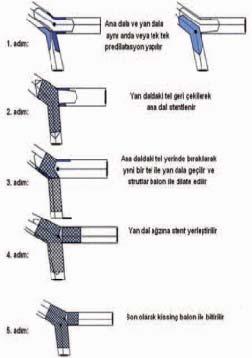 balon dilatasyon, balon dilatasyon sonrası TIMI akım 0 ise yan dal stentlenmesi uygulandı.