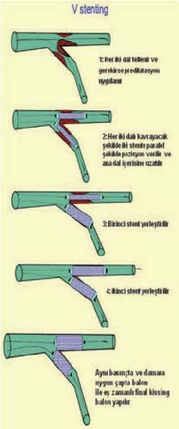 Öngörülebilir stent açısı olması Bifurkasyonda stent strutlarının homojen dağılması Dezavantajları Ana dal proksimalinde metalik yük oluşması İki defa kissing dilatasyon gerekmesi İşlem süresinin