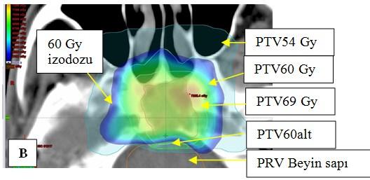 PTV 54Gy ve PTV 60Gy volümleri içinde kalan beyin sapı dozunu kontrol etmek için PTV 60 Gy volümü içine PTV60alt (A) tanımlanarak beyin sapı tolerans dozu kontrol edilmiştir (B). Şekil 3.