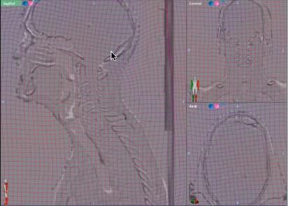 Kaus ve ark (5) bu algoritmayı (Finite Element) farklı anatomik bölgelerin tedavi planlamasında kullanmışlardır.