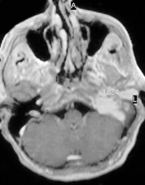 ROI 1624 (Dyn Scan) Sc 7, FFE/M, SI 1 175 14 15 16 fiekil 2. Paraganglioma olgusunun aksiyal postkontrast T 1 A ve dinamik kontrastl manyetik rezonans görüntülemede zaman sinyal e risi.