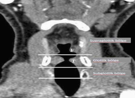 8 Resim 2.1. Larinksin alt anatomik bölümleri 2.1.3.1 Supraglottik Bölge Larinksin girişi (vestibulum larinks): laringiyal kavitenin farinkse açıldığı bir boşluktur.