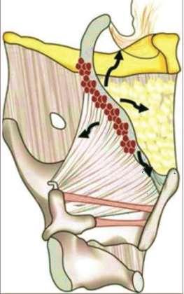 26 kaynaklananlar, epiglottaki çok sayıdaki fenestrasyonlardan dolayı tipik olarak preepiglottik mesafeye öncelikle yayılırlar (Şekil 2.