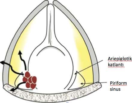 27 Şekil 2.4. Ariepiglotik katlantıdan kaynaklanan supraglotik kitle Yalancı kordda kırmızı renkte izlenen kitlenin kalın eğimli oklar ile yayılım yolları gösterilmiştir. Şekil 2.5.