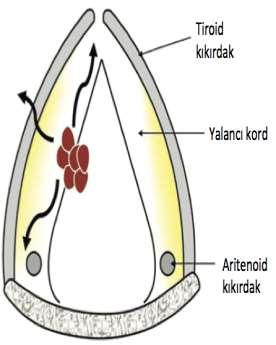 Supraglottik bölge zengin lenfatik dolaşıma sahip oldugŭndan lenf nodu tutulumu sıklıkla esļik eder. Bu oran T1-T2 tümörlerde %30, T3-T4'lerde %70 dir.