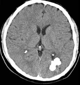 Hastaların %92 sinde nöbet başlangıç semptomudur (7). Genetik aktarımlı epilepsinin dünyadaki en sık sebebidir.