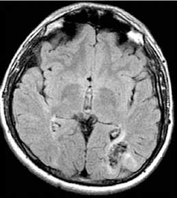 Bu derlemede, ilaca dirençli epilepsi olan, bunun dışında herhangi bir sistemik tutulum olmayan hastamıza uyguladığımız epilepsi cerrahisini ve TSK daki nöbetlerin tedavi seçenekleri hakkındaki