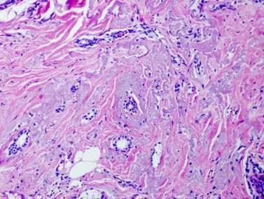 Elastozis, stromada granüler eozinofilik materyal (spesifik DEĞİL!