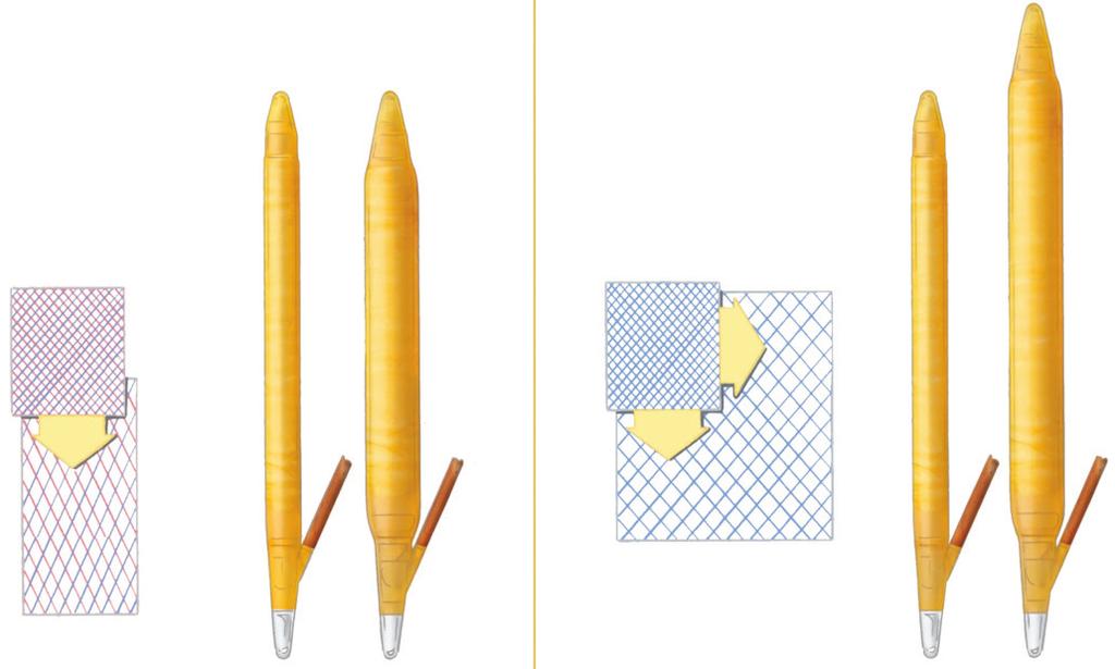 CX Enables girth expansion LGX Enables girth and length expansion Şekil 1. AMS tarafından üretilen; sadece enine genişleyebilen CR ve hem enine hem de boyuna genişleyebilen LGX penil protezi (www.