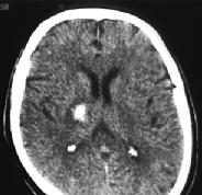 Nörooftalmolojik bulgu: İpsilateral miyosis,