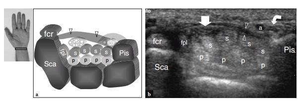 Şekil 2.6. Karpal tünelin sonografik ve şematik transvers kesiti a.