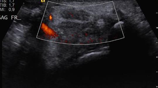 Median sinir transvers planda görüntülenip power doppler incelemesi yapıldı. Renk penceresi sinirin 3 cm lik bölümünü kapsayacak şekilde açıldı ve power doppler USG görüntüleri kaydedildi.