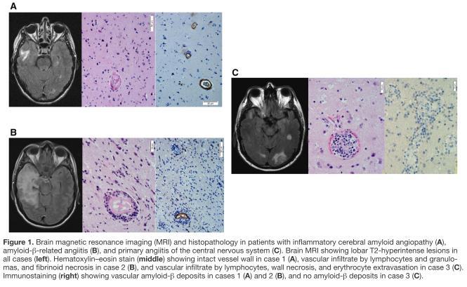 Inflamatuar Serebral Amiloid Anjiopati Primer