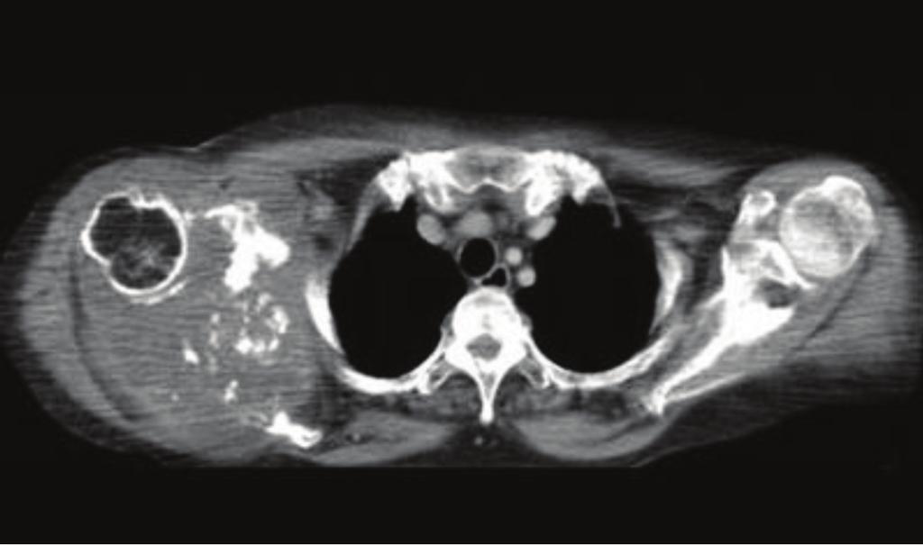 A Resim 1: Kontrastlı BT kesitinde skapulada destrüksiyona neden olan, milimetrik kalsifikasyonlar ve çevre kas planları ile konturları seçilemeyen yaklaşık 8x5 cm boyutlarında hipodens özellikte