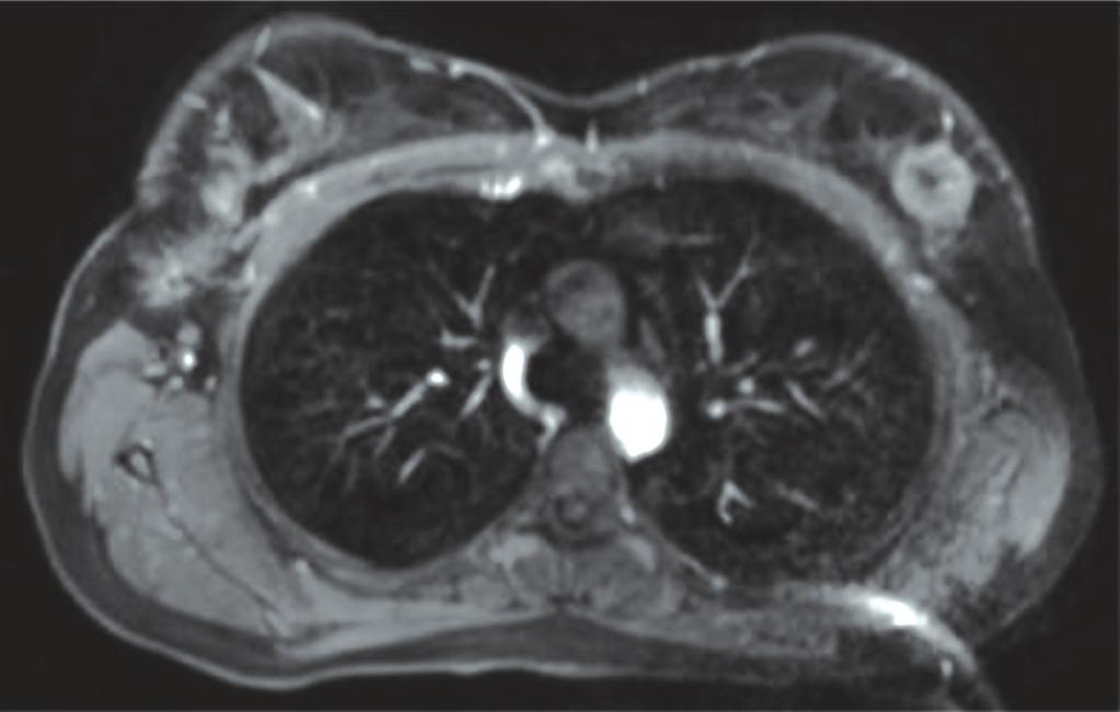 A C Resim 3a-3b-3c. Sagittal ve aksiyal yağ baskılı T2 ağırklıklı MR kesitlerinde sternumda 2x2.