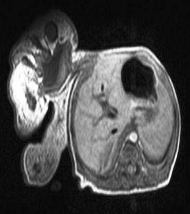 M.H. Okur ve ark., Epigastrik heterofagus ve omfolosel: Nadir görülen bir olgu sunumu sonrası 7. günde sorunsuz bir şekilde taburcu edildi. Ameliyat sonrası 3.