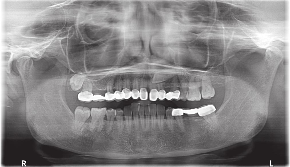 Tablo 1 Gömük dişlerin dağılımı, Çukurova Medical Journal 2014;39:559-565(3). Diş Türü Sayı (%) Maksiller santral ve kesici 8 (%0.2) Mandibuler santral ve kesici 6 (%0.1) Maksiller kanin 145 (%3.