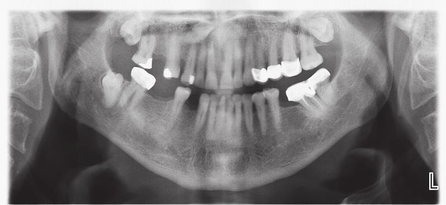 Şekil 4 18, 13, 28 ve 48 numaralı gömük dişler. molar dişlerle ilişkili patolojik durumlar, sadece radyografik inceleme sonucu düşünülenden daha fazladır.