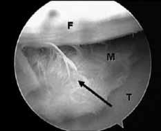 Li ve ark. Osteoartritli dizlerde menisküs yaralanmalarının artroskopik karakteristikleri 277 Tablo 1. Hastaların başlangıç verileri (n=87). Yaş 56±6.