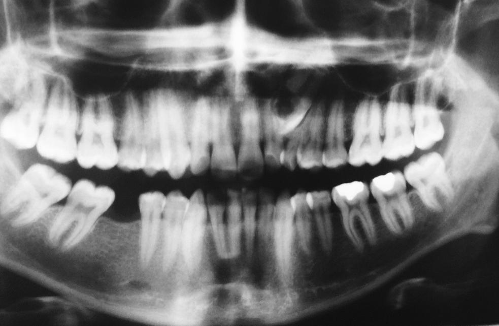 27 dolayı diş gelişimi mümkün değilse buna bağlı olarak gömülü kalıyorsa yada maloklüze ise panoramik radyografi erken teşhise yardımcıdır.