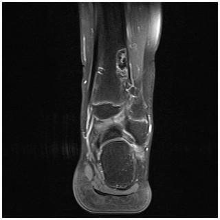 ossifaying fibrom 3-