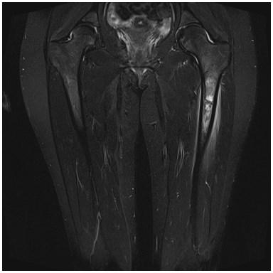 1- Osteoid