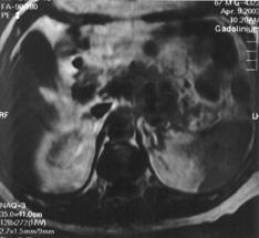 Resim 2. Bir pankreas malign tümörünün MR görünümü TARTIfiMA Pankreas kanserlerinin insidansında son yıllarda belirgin bir artı saptanmaktadır. Amerikada erkek ölümleri içerinde 4.