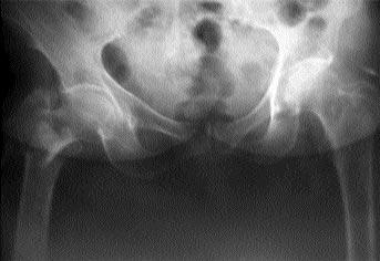 290 Acta Orthop Traumatol Turc Tablo 3. ki grubun ölüm oranlar, hareket süreleri ve komplikasyonlar Grup 1 Grup 2 nternal tespit (n=38) Hemiartroplasti (n=43) Ortalama takip süresi (ay) 22.