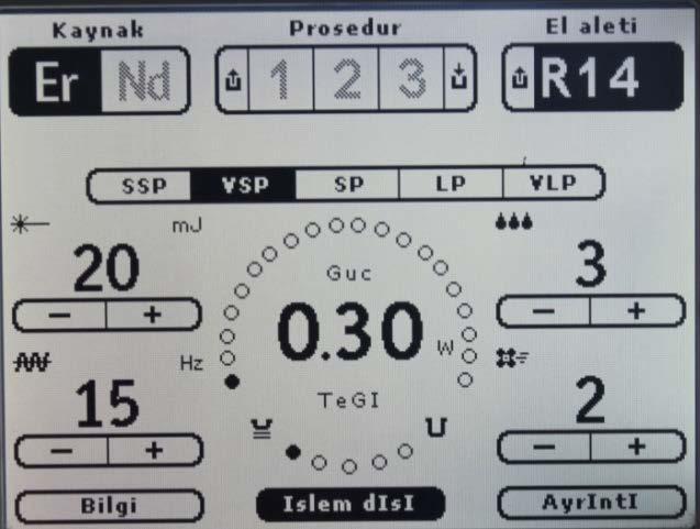 Kanal içi solüsyonu aspire etmeden mikrokanül çıkarılmıştır ve 60 saniye smear tabakasının çözünmesi beklenmiştir.