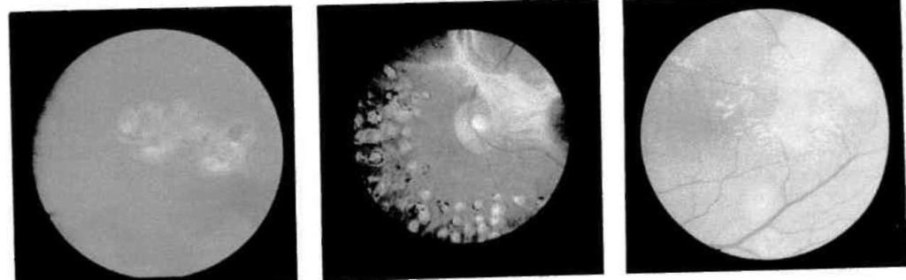 Şekil-9a: Diabetik retinopatide, xenon koagülasyonundan hemen sonra.