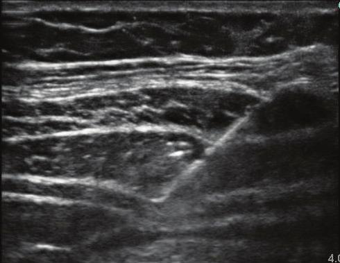 cing 100 mm long 22 G short-bevel needle (Pajunk SonoPlex Stim cannula, Geisingen, Germany) through the Petit triangle formed by crista iliaca, latissimus dorsi muscle and external oblique muscle.