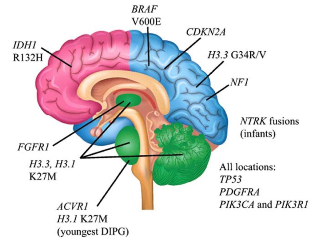 Pediatrik yüksek dereceli diffüz gliomlar Mutasyonlar Yaşa ve lokalizasyona göre değişir GLIA