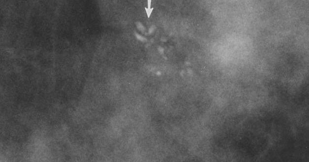 gölgelenme 1 yapısal distorsiyon Imagedetectedlobular neoplasiaof breast: morphologiccorrelation