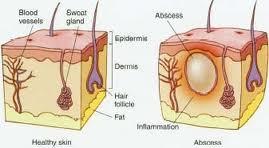 S.aureus un etken olduğu infeksiyonlar Folikülit, fronkül, karbonkül, impetigo,